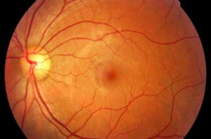 DMAE degeneracion macular salud ocular