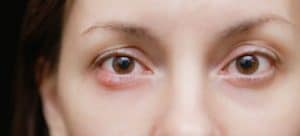 chalazion